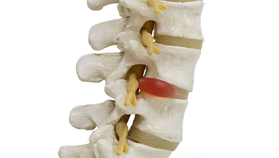 Herniated disc in spine before visiting Louisville chiropractor
