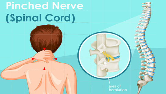 Pinched nerve in spine before chiropractic treatment from Louisville chiropractor