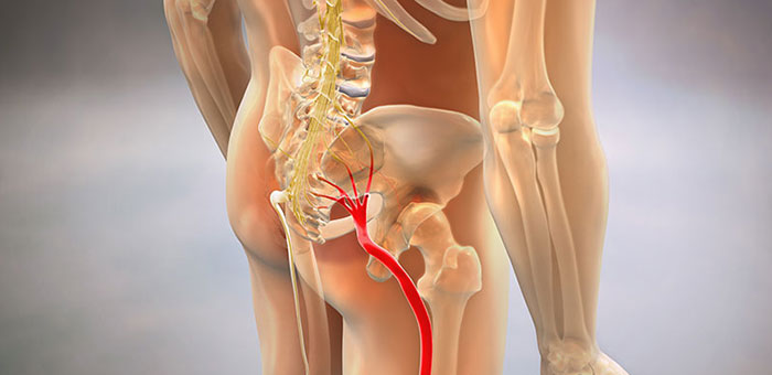 Sciatic nerve pain before chiropractic treatment from Louisville chiropractor