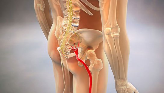 Sciatic nerve pain before chiropractic treatment from Louisville chiropractor